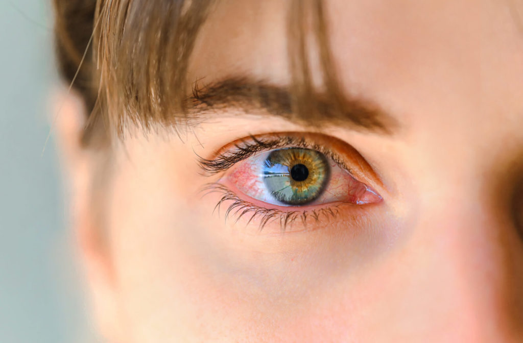 Close up image of a person's left eye showing the typical redness of pink eye.