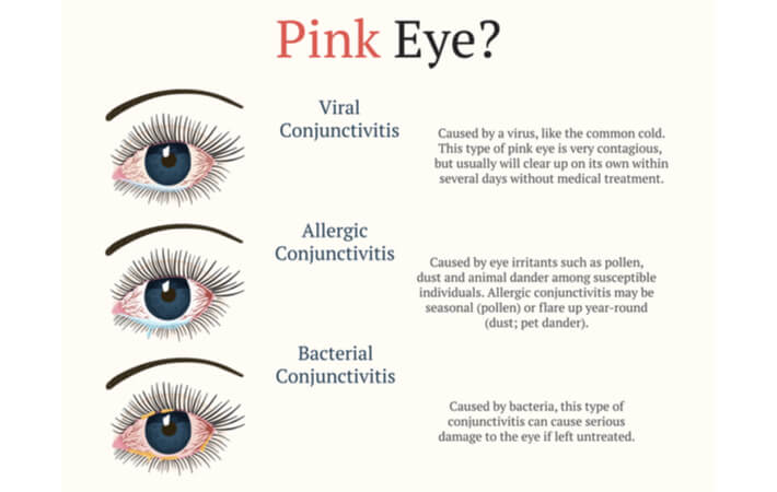 Graphical representation of three types of pink eye, showing sketches of viral, allergic, and bacterial conjunctivitis.